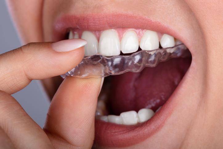 Nakładka na zęby przeciw bruksizmowi