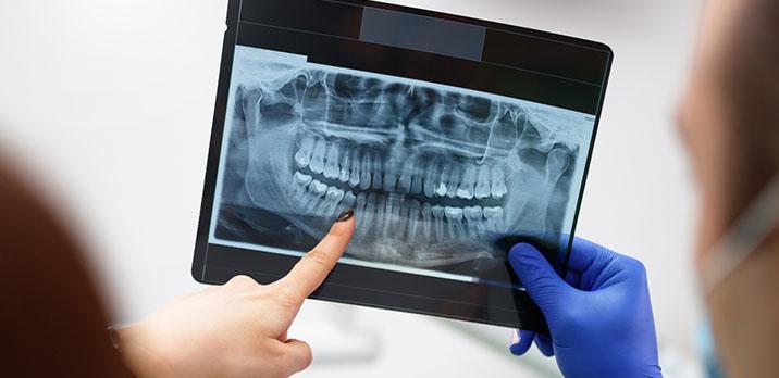Osoby oglądają rentgen zębów
